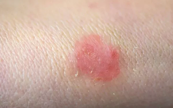 Does Ringworm Cause Blisters?