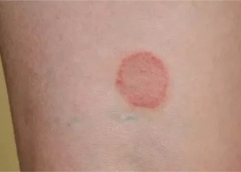 Does Ringworm Cause Blisters?