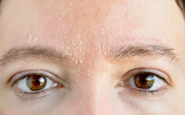 How to Treat Dry Eczema on Face