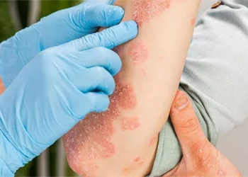How to Treat Open Eczema Wounds