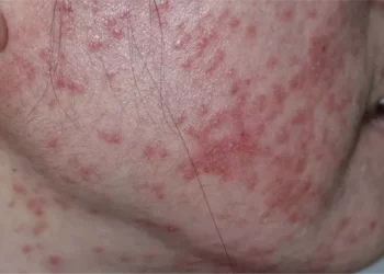 How to Treat Retinoid Dermatitis