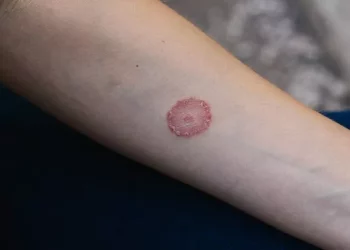 Why Does Ringworm Keep Spreading on My Body