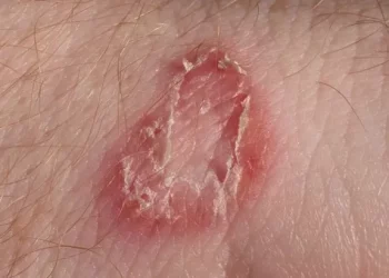 Why Does Ringworm Keep Spreading on My Body