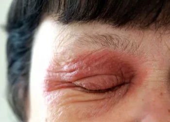How to Treat Swollen Eyes from Eczema