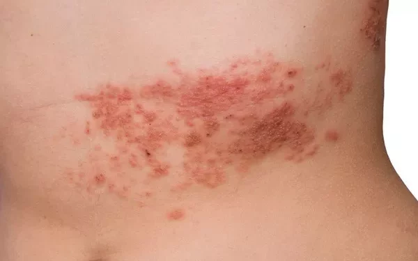 Can Adults Get Shingles When Exposed to Chickenpox?