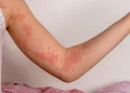 Hives