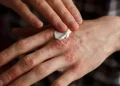 psoriasis