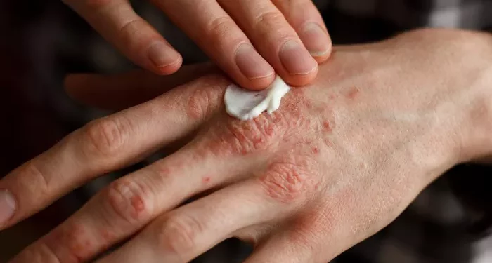 psoriasis